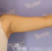 盐城东方女子医院抽脂瘦手臂案例，分享60天恢复前后对比图