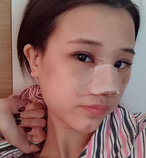 浙医二院隆鼻怎么样？介绍在线反馈，抢一波福利