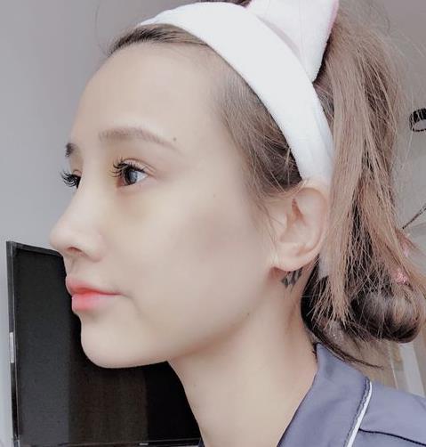 浙医二院隆鼻怎么样？介绍在线反馈，抢一波福利