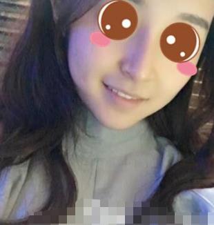 山东省立医院整形科隆鼻怎么样？术后介绍前后图