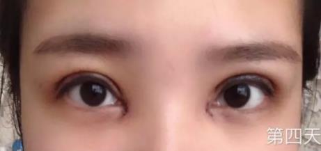 【朱晓峰】双眼皮做得如何？有术后四个月案例鉴定果