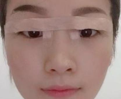 浙二医院整形科双眼皮手术介绍，恢复后反馈：灵动有神