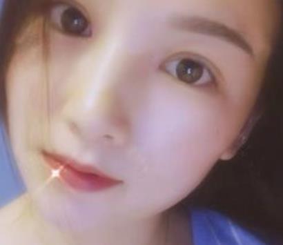 浙二医院整形科双眼皮手术介绍，恢复后反馈：灵动有神