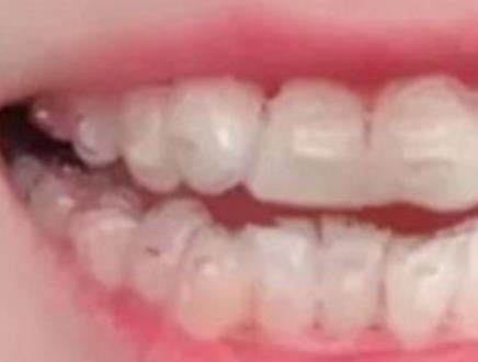 四川省人民医院整形科牙齿矫正介绍公开，终于可以放心笑