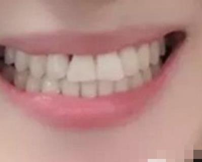 四川省人民医院整形科牙齿矫正案例对比图公开，终于可以放心笑