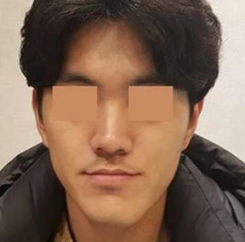 广州市第一人民医院整形外科改脸型术后流出，一览