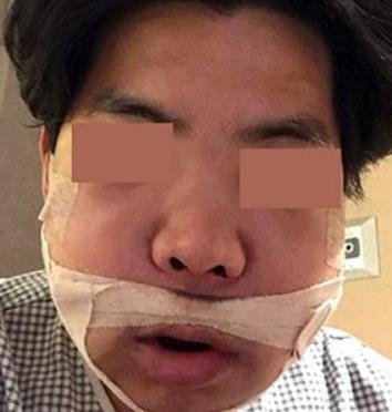 广州市第一人民医院整形外科改脸型术后流出，一览