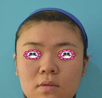 江苏省中医院整形外科隆鼻恢复记录分享，含经验果