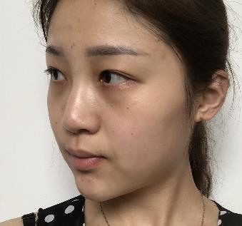 在深圳北大医院整形美容科做了隆鼻，术后经验分享