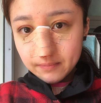 在深圳北大医院整形美容科做了隆鼻，术后经验果图分享