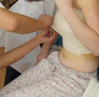 西安西京整形医院潘华医生隆胸恢复过程在线展示