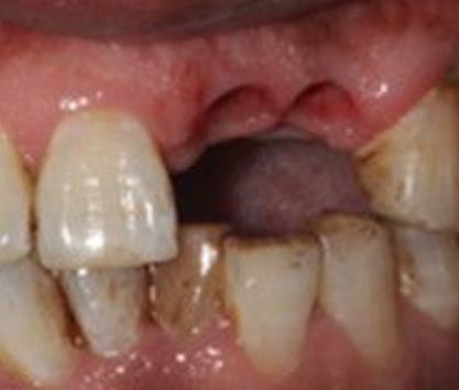 天津市口腔医院种植牙术前术后果公开进行对比，果看得见
