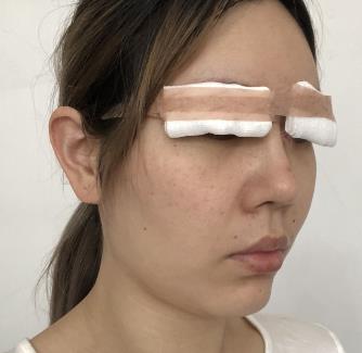 贵州省第二人民医院整形科双眼皮真人案例果对比图分享：经验