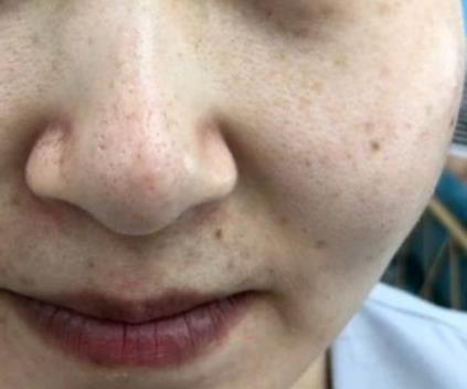 南京维多利亚整形医院激光美肤祛斑术后果分享：光洁白皙还嫩肤