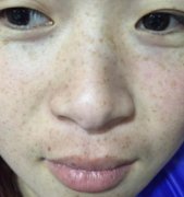武汉协和医院美容科去黄褐斑案例图展示&三个月恢复果