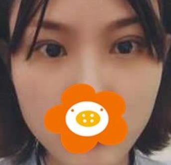常州曙光医院割双眼皮正规吗?术后分享