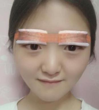 南京鼓楼医院整形科双眼皮怎么样？2个月果分享可参考