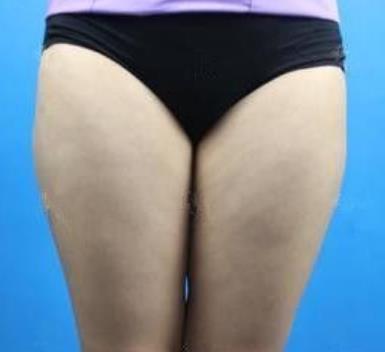 西京医院整形科吸脂瘦大腿介绍，两个月恢复果分享