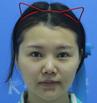 上海九院做面部提升医生名单，介绍反馈：一下年轻了好几岁！