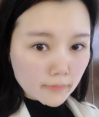 上海九院做面部提升医生推荐，案例反馈：一下年轻了好几岁！