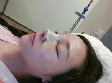 在长沙美莱潘卫峰2020年做假体隆鼻3个月恢复照在线实时分享