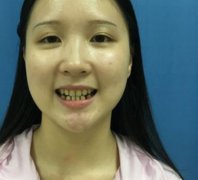 徐州医科大学附属医院口腔科整牙案例和果对比图分享