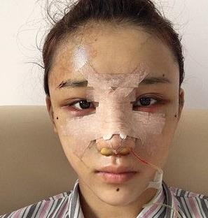 重庆西南医院整形科隆鼻案例展示：术后获得立体五官！