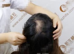北京新生植发医院头顶加密植发8个月果图,还前后对比照哦！