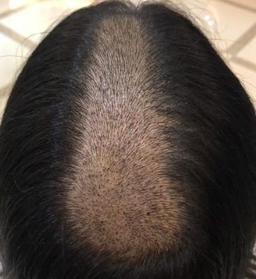 北京新生植发医院头顶加密植发8个月果图,还前后对比照哦！