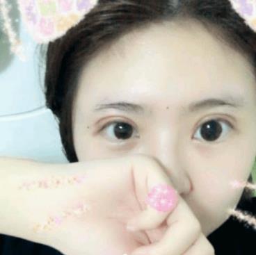 深圳美莱医疗美容医院双眼皮术后果分享