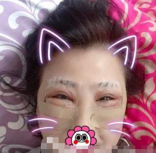 哈尔滨211医院美容科去眼袋介绍