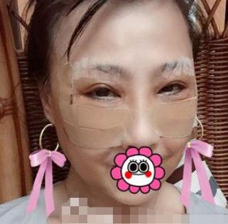 哈尔滨211医院美容科去眼袋介绍