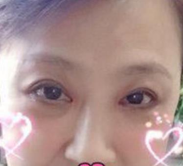 哈尔滨211医院美容科去眼袋介绍