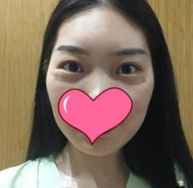 四川大学华西医院整形外科去眼袋介绍恢复前后图