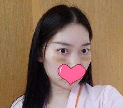 四川大学华西医院整形外科去眼袋介绍恢复前后图