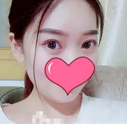 四川大学华西医院整形外科去眼袋介绍恢复前后图