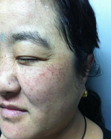 贵州人民医院美容科祛斑介绍，手术项目费用（价格）咨询