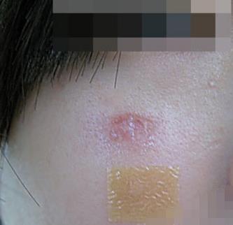 上海民航医院美容科去疤痕怎么样？介绍前后图分享