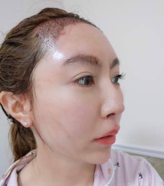 广东省人民医院可以植发吗？发际线种植案例展示，术后年轻了好几岁！