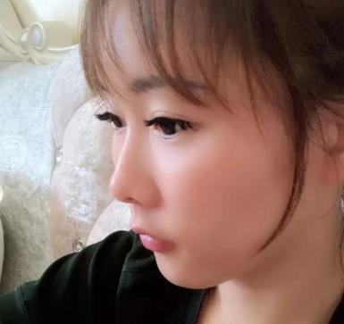 嘉兴曙光高峻面部脂肪填充果怎么样？介绍参照