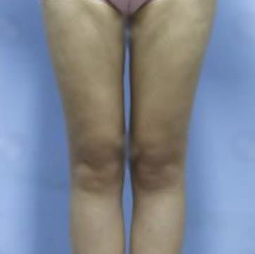 北京朝阳医院整形外科大腿吸脂案例果对比一览，轻松甩脱大象腿