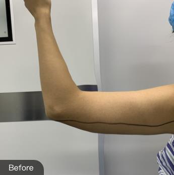 沈阳军区总医院整形美容科手臂抽脂前后照-恢复经历过程