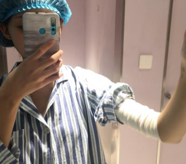 沈阳军区总医院整形美容科手臂抽脂前后照-恢复经历过程