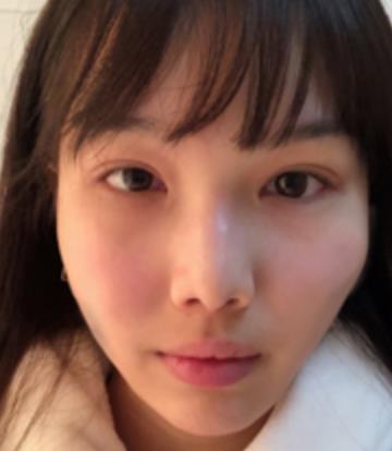 张笑天医生磨骨怎么样？介绍果证实专家的技术很