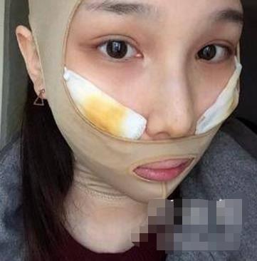 张笑天医生磨骨怎么样？介绍果证实专家的技术很