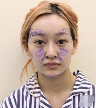 上海九院整形外科曹卫刚脂肪面部填充介绍分享，靠实力说话！