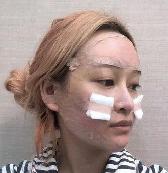 上海九院整形外科曹卫刚脂肪面部填充介绍分享，靠实力说话！