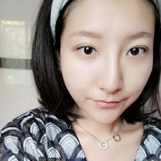 南京亚韩整形医院激光美肤后果，小姐姐至少年轻10岁