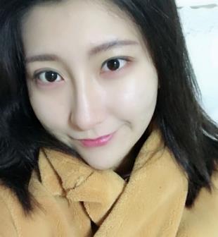 南京亚韩整形医院激光美肤后果，小姐姐至少年轻10岁