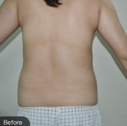 包头华美徐三明腰腹部吸脂一年后果图，康康我的腰围细了多少!